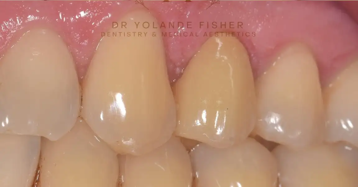 After Aesthetic Treatment